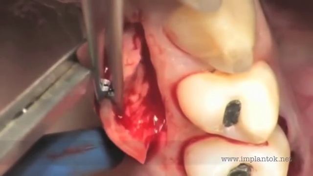 Active Implant