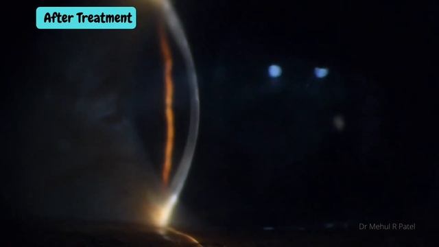 Keratic Precipitates | KPs | Uveitis | Anterior Uveitis | Herpes Simplex Virus смотреть онлайн