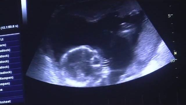 Ultrasound 17w3d with song Open Up Heaven by Kim Walker смотреть онлайн