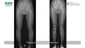 Об операции по коррекции кривизны ног в Клинике ортопедической хирургии Ёнсе Ли Дон Хун