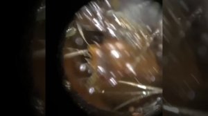 165 - Totally Blocked Ear Wax Impaction Removal using the WAXscope®️