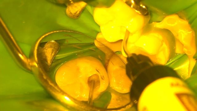 Лечение кариеса нижнего моляра методом окклюзионного композитного ключа Flow методикой смотреть онлайн