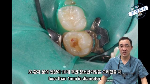 작아보이던 충치의 대반전, 작은 충치라고 방심했다가 신경치료까지 하게 된 사연