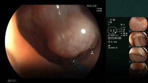 Эндоскопическая резекция крупного полипа сигмовидной кишки