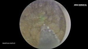 Фрагментация камней мочевого пузыря на лазере MultiPulse HoPLUS  150W.