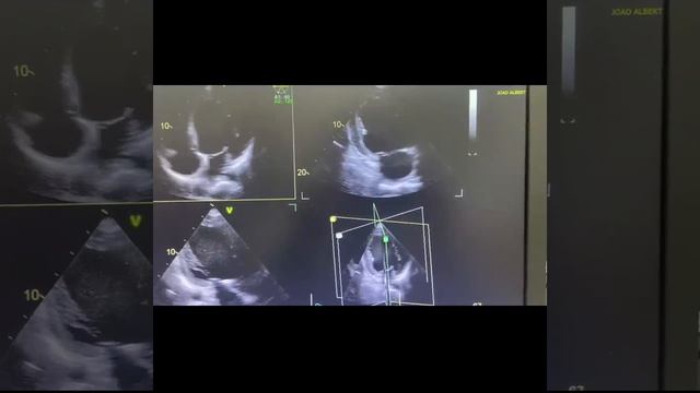 Bivalved aorta with severe insufficiency and coarctation of the aorta at age 21 смотреть онлайн