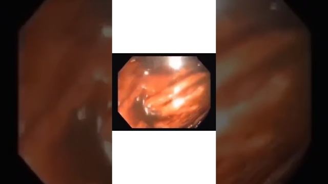 Здоровье и кишечник