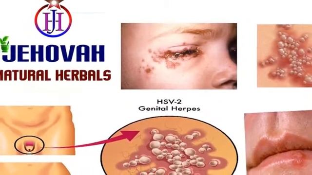 Herpes Simplex Virus-SUPER MAYA- JEHOVAH NATURAL HERBALS-9943344006 - CHENNAI смотреть онлайн