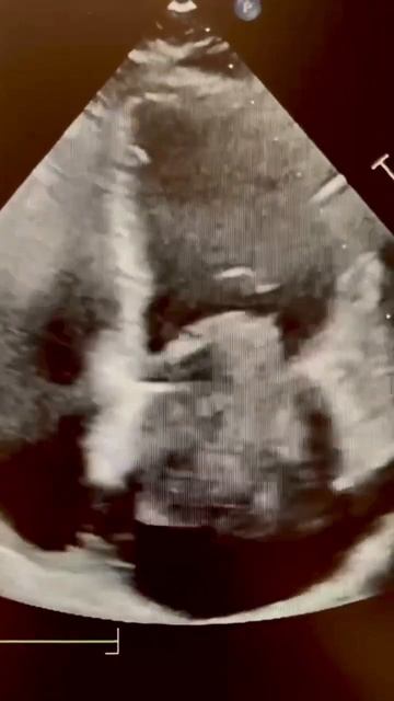 Left Atrial Myxoma echocardiography echocardiogram cardiology