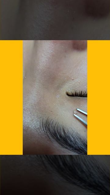 Milia Removal at Derma Elite 101 смотреть онлайн