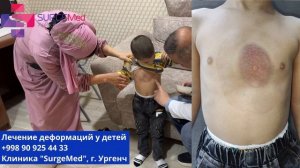 Вакуумный колокол 12 см в лечение воронкообразной деформации у мальчика 4 года, Узбекистан, Ургенч