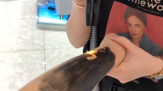 Nd Yag laser Treatment work & Procedure. смотреть онлайн