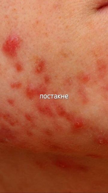 Лучшее средство от расширенных пор, постакне и чёрных точек! #расширенныепоры #постакне #черныеточк