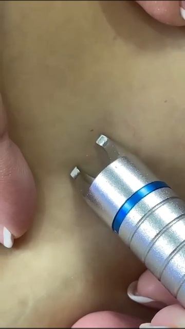 Диодный лазер для удаления сосудов смотреть онлайн