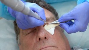 Лазерное удаление новообразований CO2