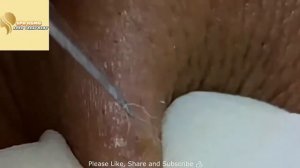 BIG Blackheads Removal   Acne Treatment   SPA ASMG   Blackheads Выдавливание черных точек