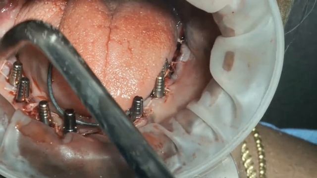 live - intraoral syncrystallisation with single titanium wire