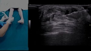 ANKLE-block БЕЗ ПРЕЛЮДИЙ #узи #anatomy #ultrasound #нервы