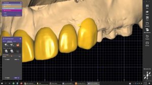 exocad wax up mock up