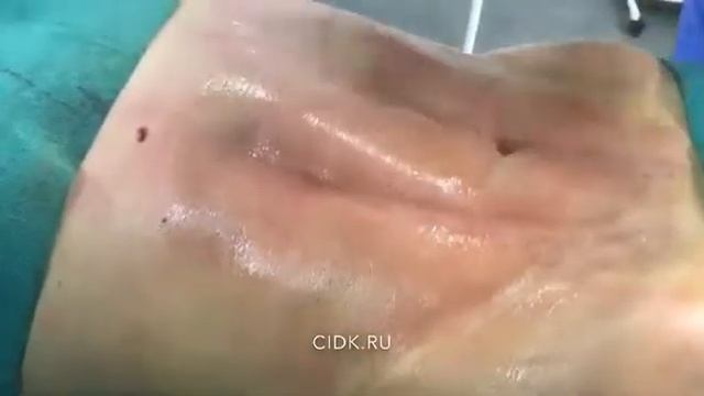 Липофиллинг в цидк! смотреть онлайн