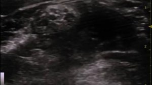 Блокада верхнего ствола (с5-с6) плечевого сплетения под УЗ контролем/USG upper trunk block