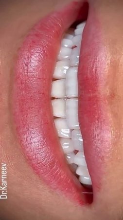 E.max veneers