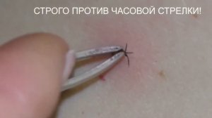 Как ВЫТАЩИТЬ КЛЕЩА