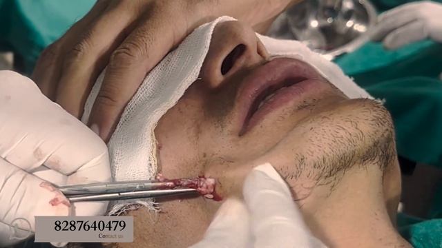 Secrets of Successful Sebaceous Cyst Removal | Awish Clinic | Sebaceous Cyst Remove | #viral смотреть онлайн