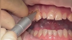 Гингивэктомия десны лазером