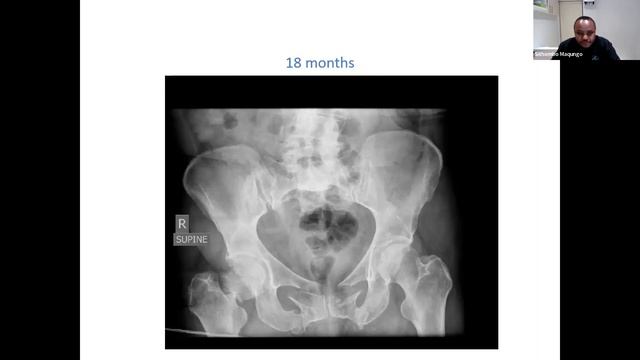 Prof Sithombo Maqungo- Pelvic fragility fractures