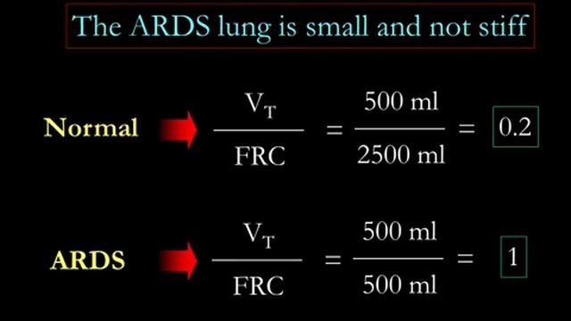 A basic introduction to the pathophysiology of ARDS Gattinoni Luciano 2018