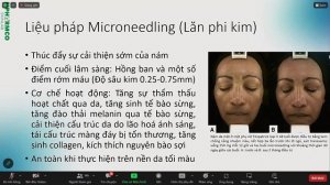 MESOTHREPY TRONG ĐIỀU TRỊ NÁM