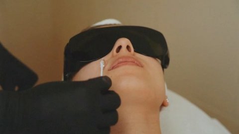 Лазерная эпиляция