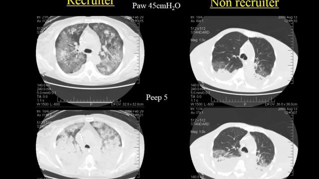 A basic introduction to the pathophysiology of ARDS Luciano Gattinoni 2016