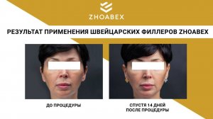 Коррекция нижней трети лица филлерами ZHOABEX VOLUME