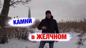 Камни в желчном пузыре.