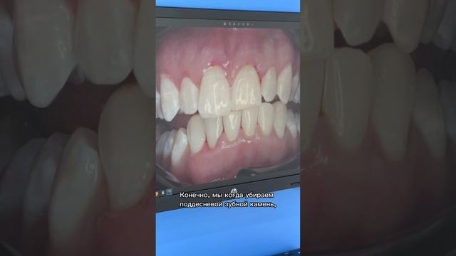 Профилактическая чистка и фторирование. Часть 2 смотреть онлайн