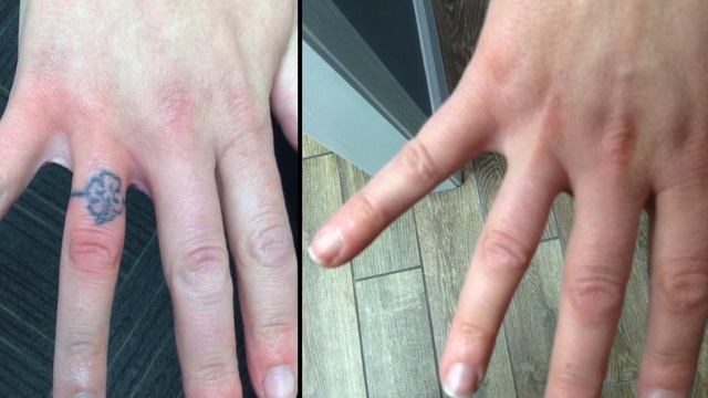 Before and After Laser Tattoo Removal смотреть онлайн