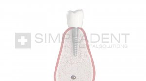 Двухэтапная имплантация с отсроченной нагрузкой  Simpladent Симпладент