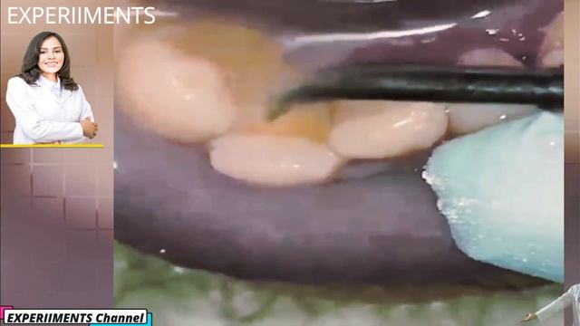 Very heavy Tartar Removal ! Restoring A Tooth Back To Original Shape! This patient was Dental phobi смотреть онлайн