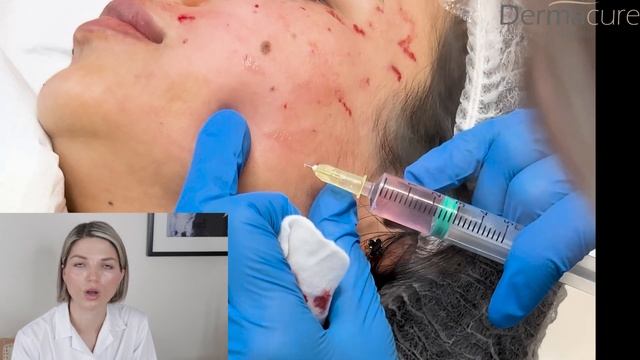 Mesotherapy for face- full demo and point by point injection technique