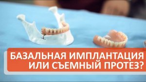 Преимущества базальной имплантации зубов по сравнению со съемным протезированием. Симпладент.