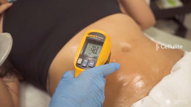 vShape Ultra Body Contouring & Skin Tightening at Dermace Laser Clinic смотреть онлайн