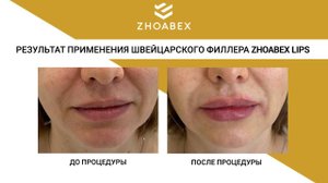 Восстановление естественного объема губ с применением филлера ZHOABEX LIPS