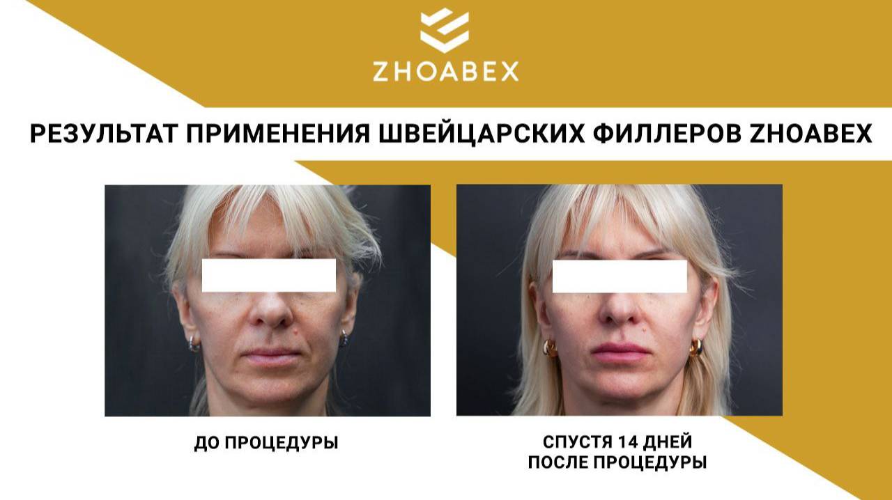 Протокол комплексной коррекции лица Full Face швейцарскими филлерами ZHОABEX.