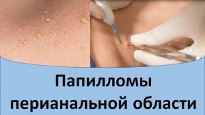 Папилломы перианальной области