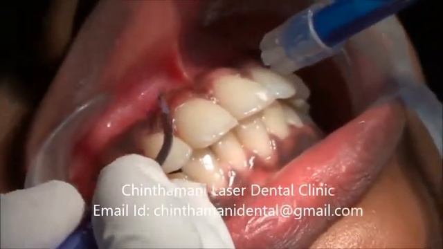 Depigmentation of Gingiva using Zolar Diode Laser video Part 1 смотреть онлайн