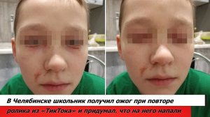 В Челябинске школьник получил ожог при повторе ролика из «ТикТока» и придумал, что на него напали