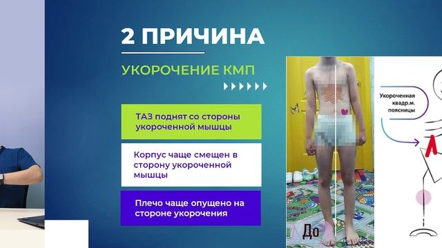 Как устранить перекос таза