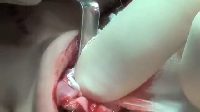 3 A Complete Subperichondrial Dissection Tec открытая смотреть онлайн